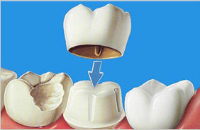 Coroa total posterior